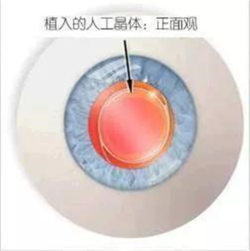 因为一般2周后术眼已基本恢复,此时可以初步判断已植入的人工晶体度数